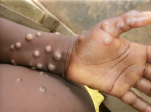 OMS decreta emergência de saúde internacional após surto de mpox na África