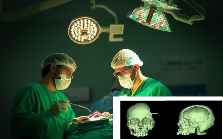 Hospital Metropolitano faz 1ª reconstrução de crânio com prótese sob medida 3D